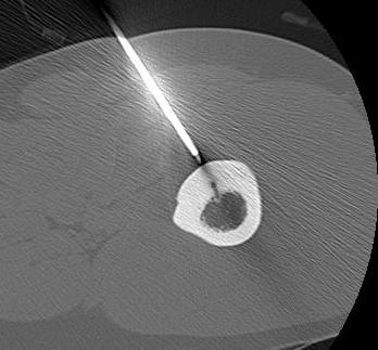 Osteoid Osteoma Radiofrequency Ablation0001